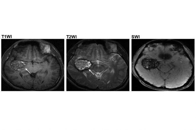 CCM二型患者于脑血管中长有爆谷形状肿瘤（箭嘴示）